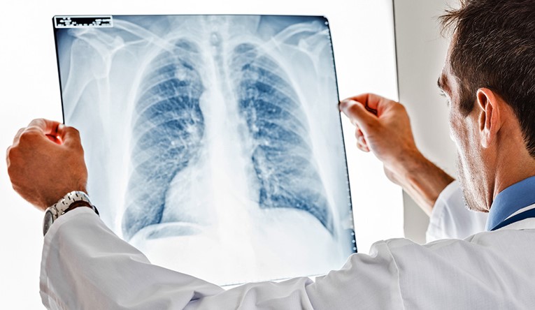 Doctor Looking at a Lung Cancer Scan